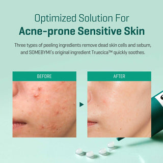 SOMEBYMI's AHA BHA PHA 14 Days Super Miracle Spot All Kill Cream is an optimized solution for acne-prone, sensitive skin. It uses three types of peeling ingredients to remove dead skin cells and sebum, while SOMEBYMI's original ingredient Truecica™ quickly soothes. The image shows before and after results: troubled skin before and clearer skin after.