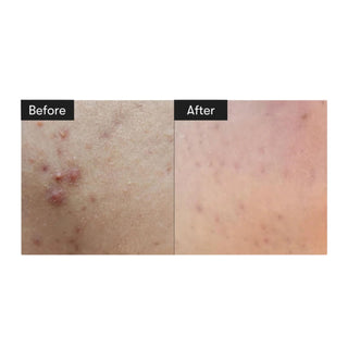 Before and after images show noticeable improvements in clearer, brighter skin and faded hyperpigmentation after using Reedle Shot 300.